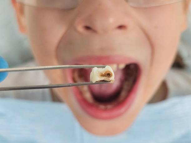 Best Emergency Treatment for Dental Infections or Abscesses in Clarendon, TX